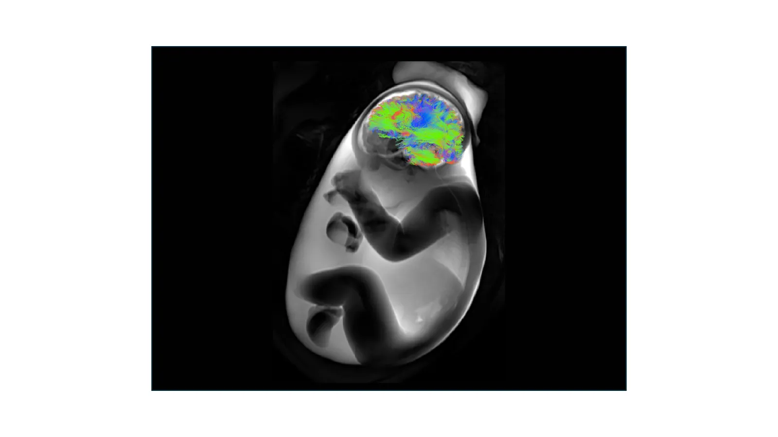 infant in the womb with brain white matter tracts highlighted
