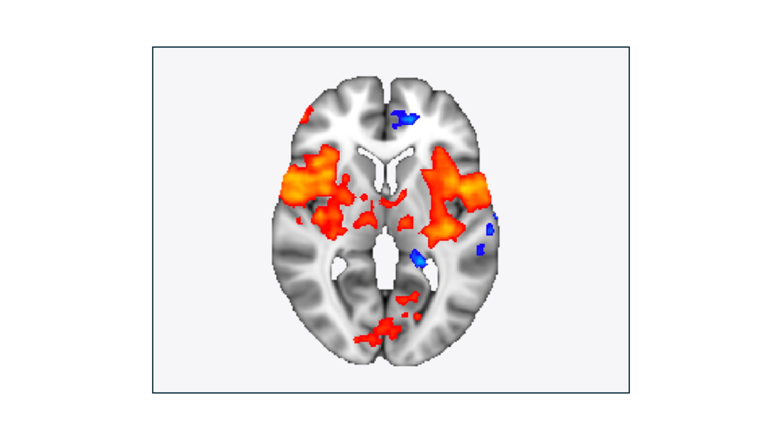 brain image highlighting leg pain in orange
