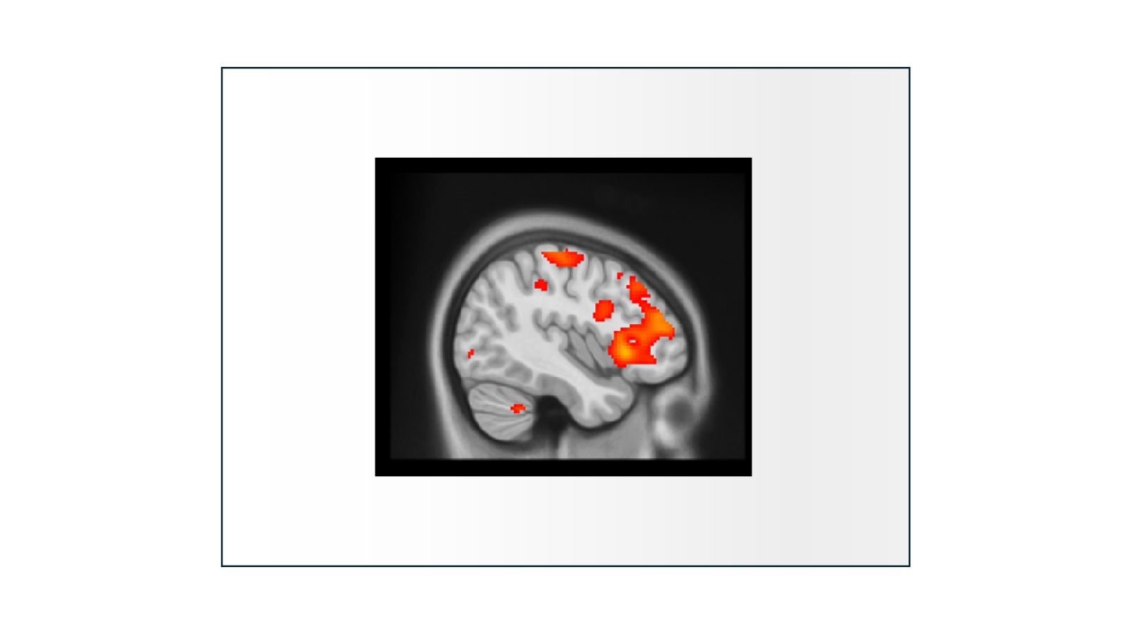 functional MRI of brain
