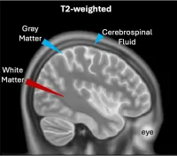 brain mri highlighted gray matter